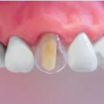 Coroane transparente cape dinti celuloid set pt frontali adulti 64 buc - imagine 4