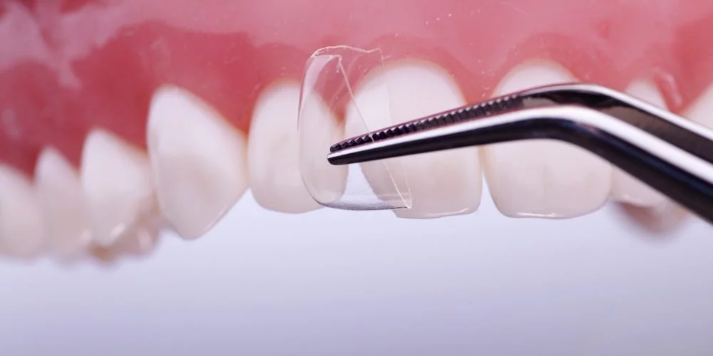 Coroane transparente cape dinti celuloid set pt frontali adulti 64 buc - imagine 2