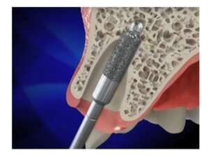 top-drill-surgical-sinus-lifting-diamond-bur (1)