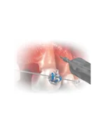 Adaptor Mini suruburi ortodontici dimensiune 1.4 - imagine 2